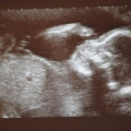 Baby scan
